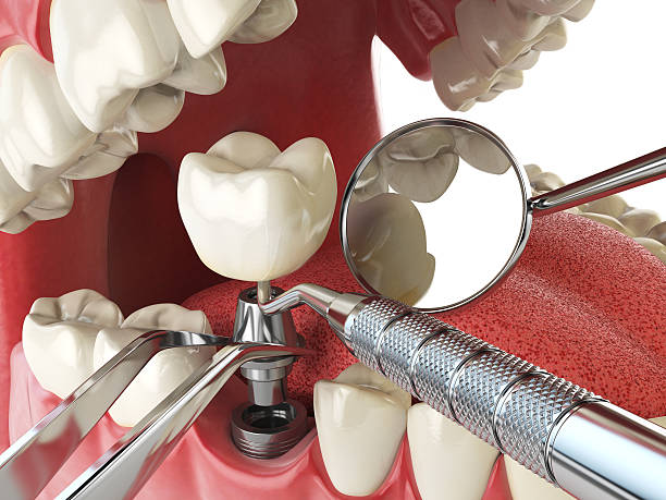 Best Knocked-Out Tooth Emergency  in Grandview Plaza, KS