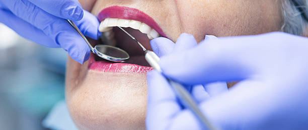 Teeth Whitening in KS